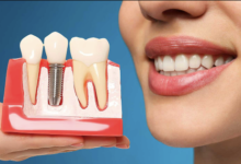 Practical Tips for Maintaining Dental Implants for Optimal Longevity