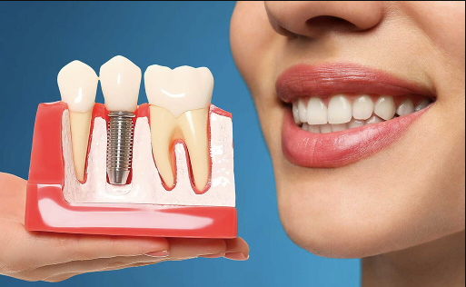 Practical Tips for Maintaining Dental Implants for Optimal Longevity