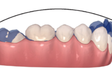 How Orthodontists Correct a Deep Curve of Spee