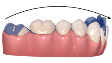 How Orthodontists Correct a Deep Curve of Spee