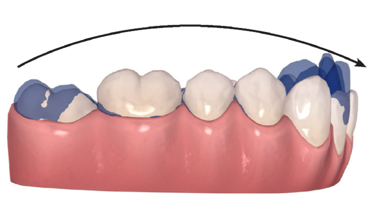 How Orthodontists Correct a Deep Curve of Spee