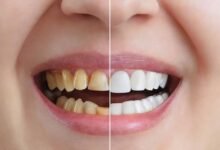 5 Ways Cosmetic Dentistry Can Be Conservative And Tooth Sparing