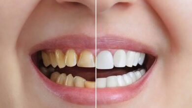 5 Ways Cosmetic Dentistry Can Be Conservative And Tooth Sparing