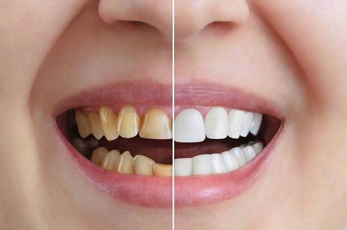 5 Ways Cosmetic Dentistry Can Be Conservative And Tooth Sparing