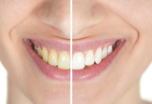 Cosmetic Solutions For Teeth Darkened By Previous Dental Work
