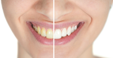 Cosmetic Solutions For Teeth Darkened By Previous Dental Work